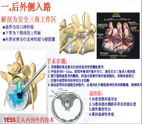 椎间孔镜入路方式