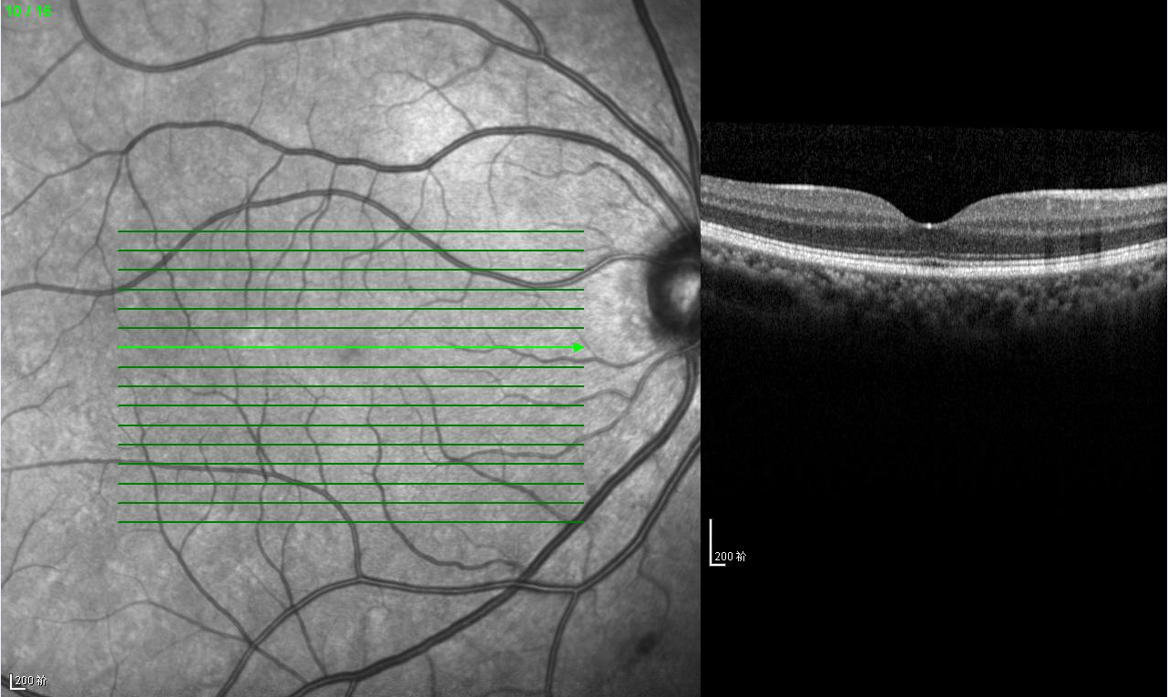 oct走进视网膜的微观世界