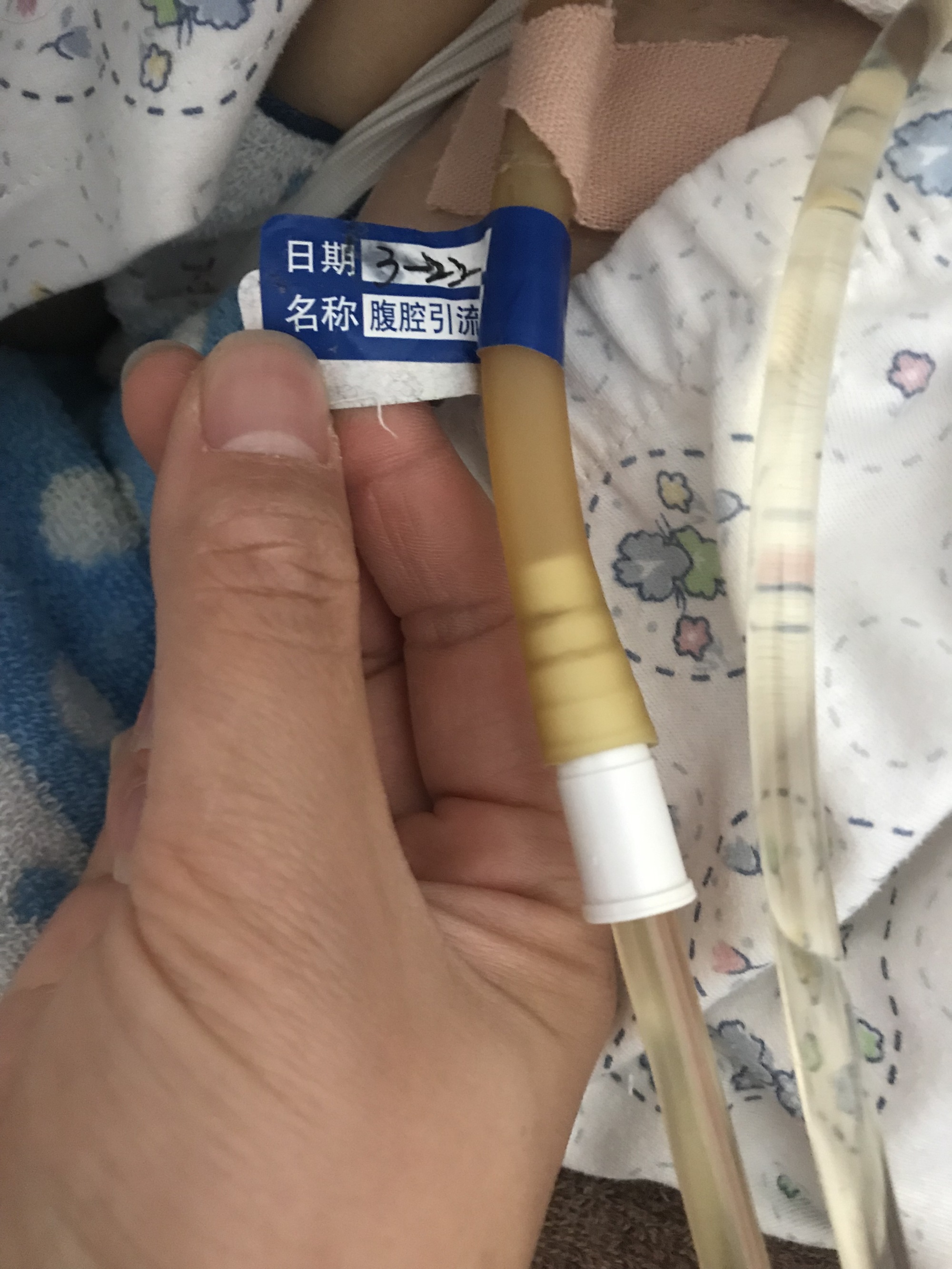 腹腔引流管