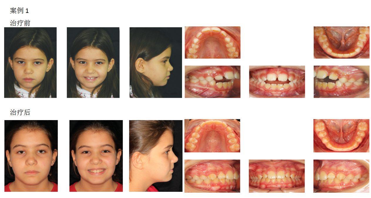 儿童牙齿早期矫正